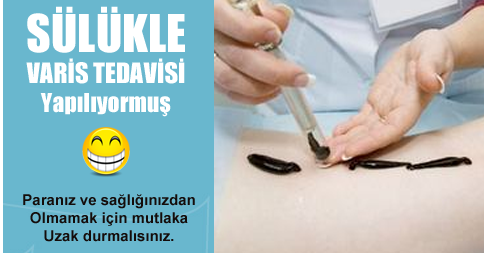 Sülükle Varis Tedavisi