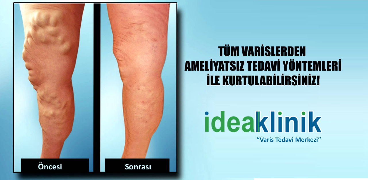 IDEA Klinik Varis Tedavi Merkezi